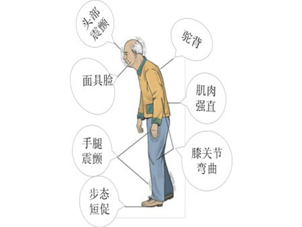 1500007598441894.jpg 帕金森1.jpg