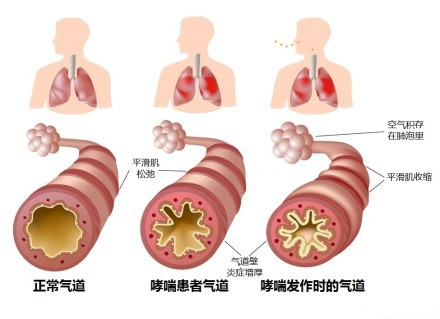 1501228678355827.jpg 哮喘.jpg